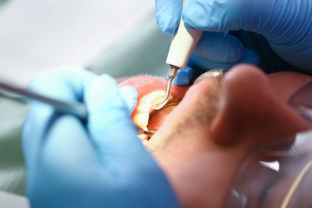 Best Emergency Dental Care for Broken or Chipped Teeth in Mansfield, OH