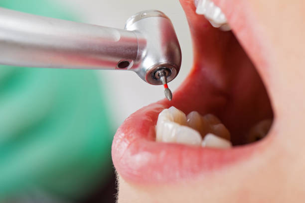 Best Emergency Tooth Extraction in Mansfield, OH